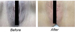 Anal Bleaching Results Comparison: Before & After